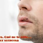 herpes