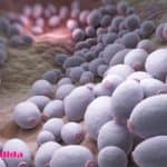 candidiasis vaginal