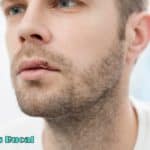 Herpes labial